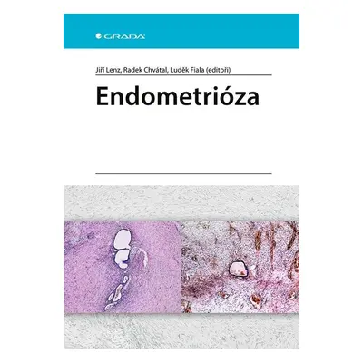 Endometrióza - kolektiv autorů