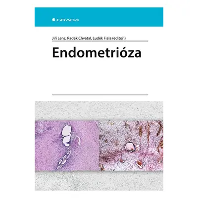 Endometrióza - Jiří Lenz