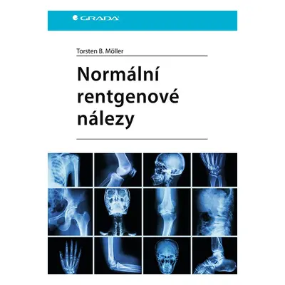 Normální rentgenové nálezy - Torsten B. Möller