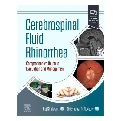 Cerebrospinal Fluid Rhinorrhea, Comprehensive Guide to Evaluation and Management Elsevier