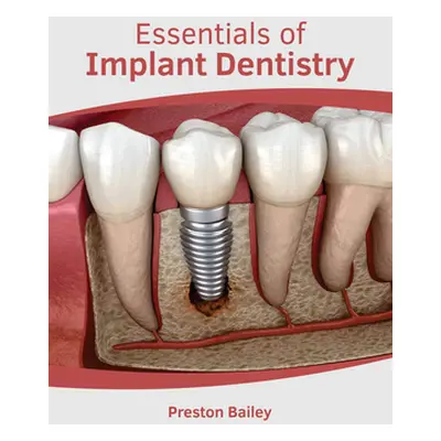 "Essentials of Implant Dentistry" - "" ("Bailey Preston")(Pevná vazba)