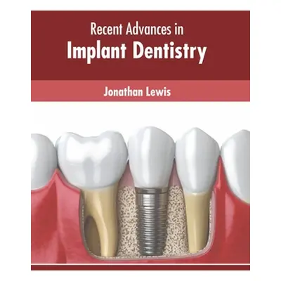 "Recent Advances in Implant Dentistry" - "" ("Lewis Jonathan")(Pevná vazba)