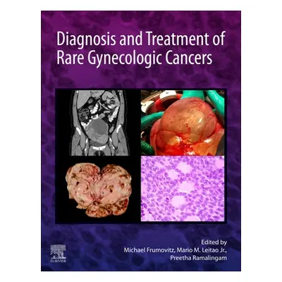 "Diagnosis and Treatment of Rare Gynecologic Cancers" - "" ("Frumovitz Michael")(Pevná vazba)