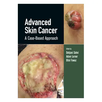 "Advanced Skin Cancer: A Case-Based Approach" - "" ("Sahni Debjani")(Pevná vazba)