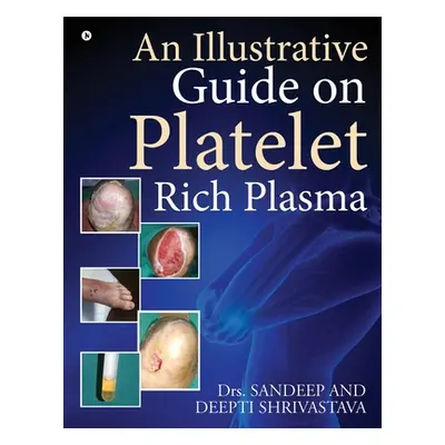 "An Illustrative Guide on Platelet Rich Plasma" - "" ("Dr Sandeep")(Paperback)