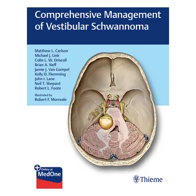 "Comprehensive Management of Vestibular Schwannoma" - "" ("Carlson Matthew L.")(Pevná vazba)