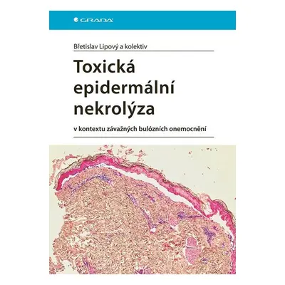 Toxická epidermální nekrolýza v kontextu závažných bulózních onemocnění - Lipový Břetislav