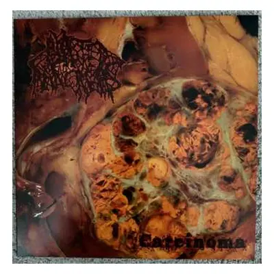 LP Blasted Pancreas: Carcinoma CLR | LTD