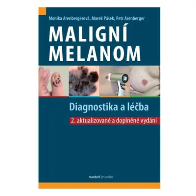 Maligní melanom - Diagnostika a léčba