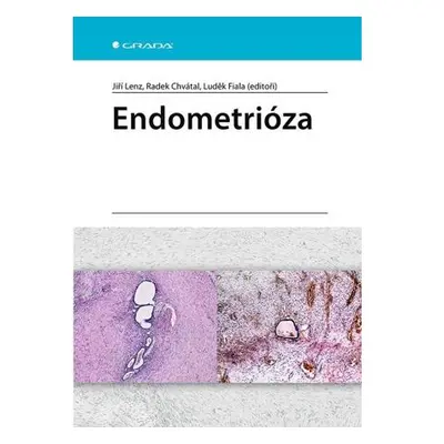 Endometrióza