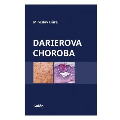 Darierova choroba