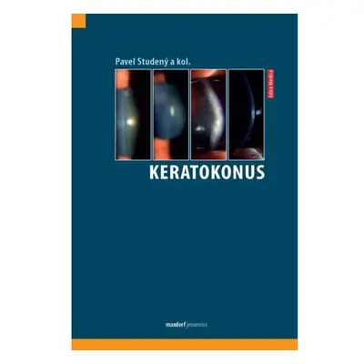 Keratokonus