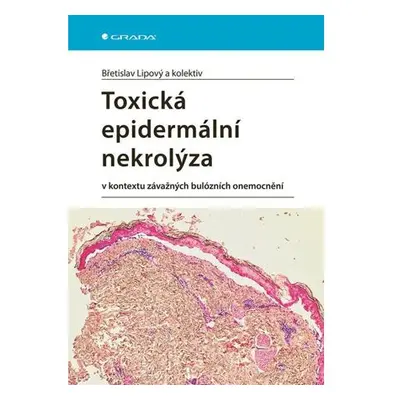 Toxická epidermální nekrolýza v kontextu závažných bulózních onemocnění