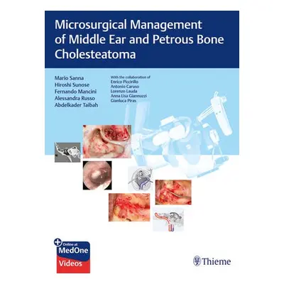 Microsurgical Management of Middle Ear and Petrous Bone Cholesteatoma - Sanna, Mario a Sunose, H