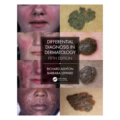 Differential Diagnosis in Dermatology - Ashton, Richard a Leppard, Barbara