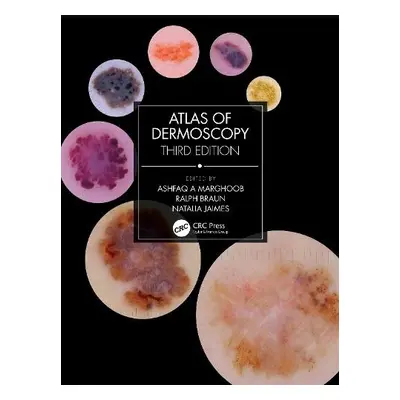 Atlas of Dermoscopy