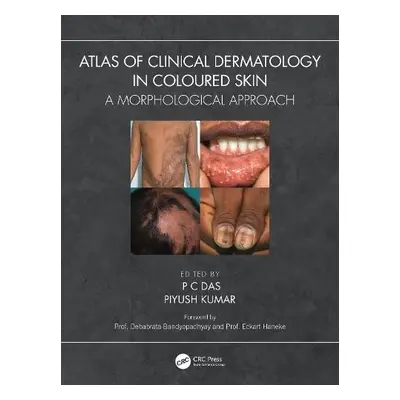 Atlas of Clinical Dermatology in Coloured Skin