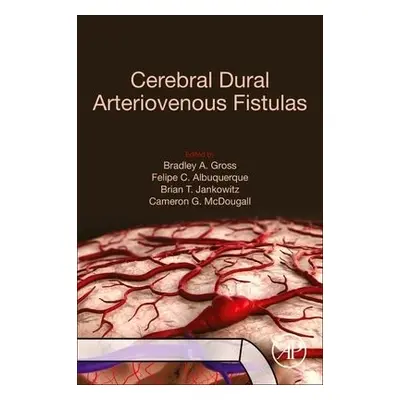 Cerebral Dural Arteriovenous Fistulas