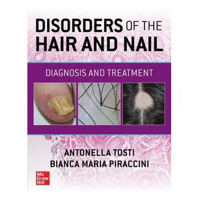 Disorders of the Hair and Nail: Diagnosis and Treatment - Tosti, Antonella a Piraccini, Bianca M