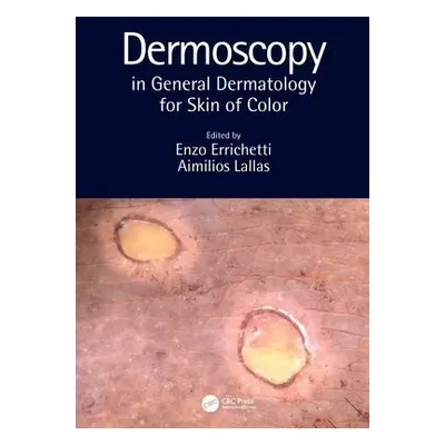 Dermoscopy in General Dermatology for Skin of Color