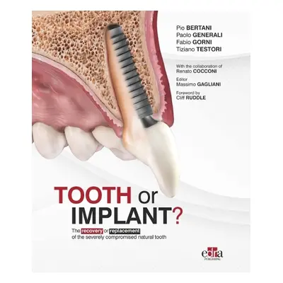 Tooth or Implant - Generali, Paolo a Gorni, Fabio a Testori, Tiziano