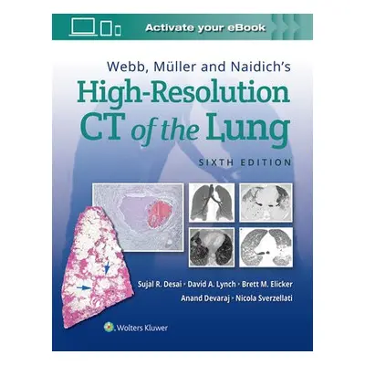 Webb, Muller and Naidich's High-Resolution CT of the Lung - Desai, Sujal a Lynch, David a Elicke