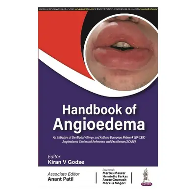 Handbook of Angioedema - Godse, Kiran V a Patil, Anant